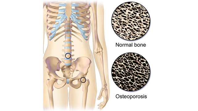 How to prevent osteoporosis and treatments of osteoporosis