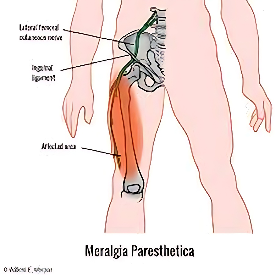 meralgia Parensthetica