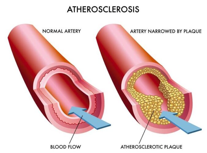 Atherosclerosis heart desease