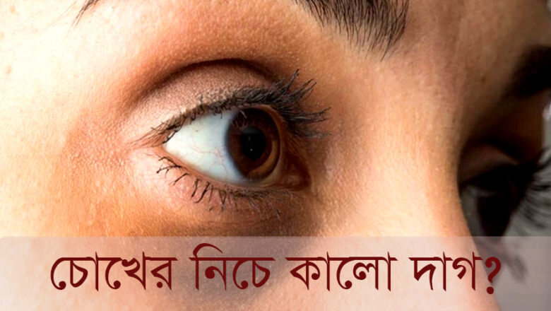 চোখের নিচে কালো দাগ দূর করবেন কী করে?