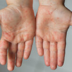 hand, foot and mouth diseases