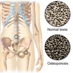 How to prevent osteoporosis and treatments of osteoporosis