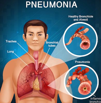 নিউমোনিয়ার লক্ষণ কী নিউমোনিয়া হলে কী করবেন