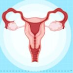 uterine tumour fibroid