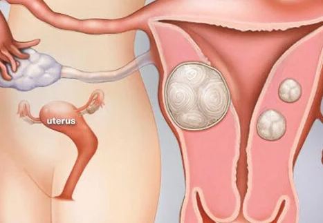 uterus tumor symptoms