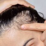 Medical Article on Scalp Psoriasis