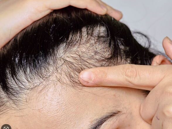 Medical Article on Scalp Psoriasis