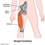meralgia Parensthetica