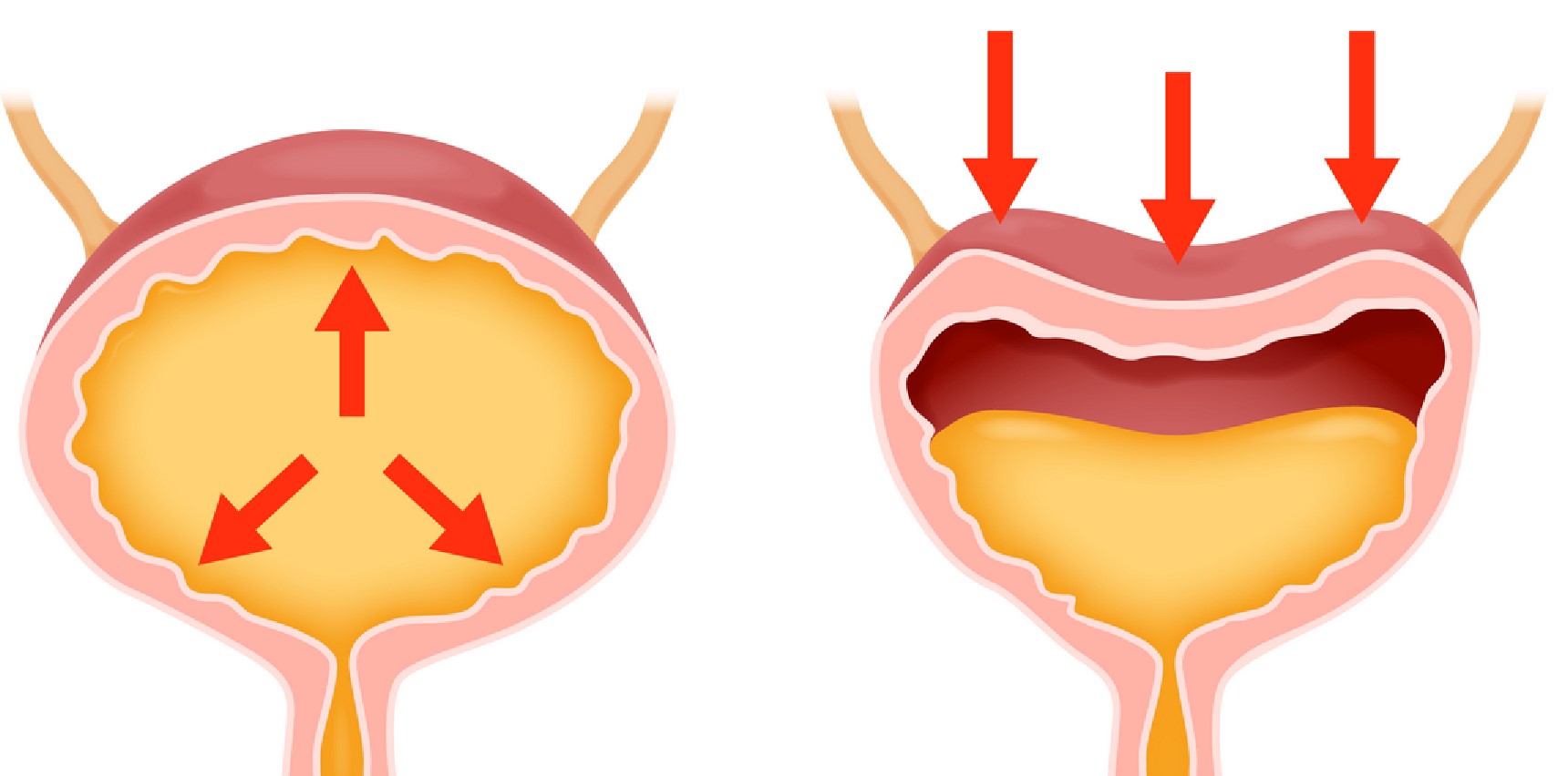 urinary-incontinence-all-you-need-to-know