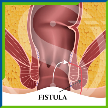 Understanding Fistula: Causes and Solutions