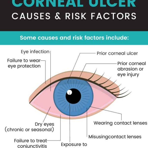 Understanding Corneal Ulcers: Causes, Symptoms, and Effective Treatments