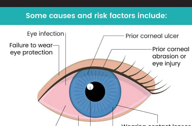 Understanding Corneal Ulcers: Causes, Symptoms, and Effective Treatments