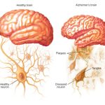 আলঝেইমার্স শনাক্তকরণ চীনা প্রযুক্তি