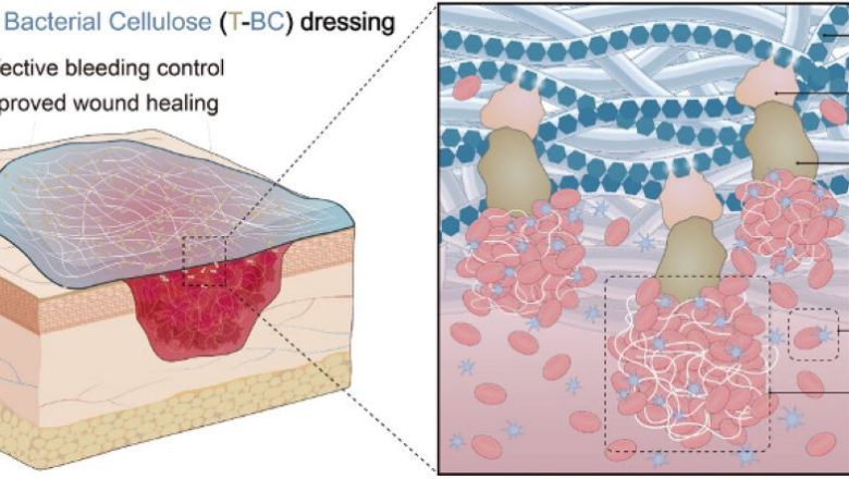 পোড়া ঘায়ের চিকিৎসায় ব্যাকটেরিয়া সেলুলোজ ড্রেসিং আবিষ্কার চীনে